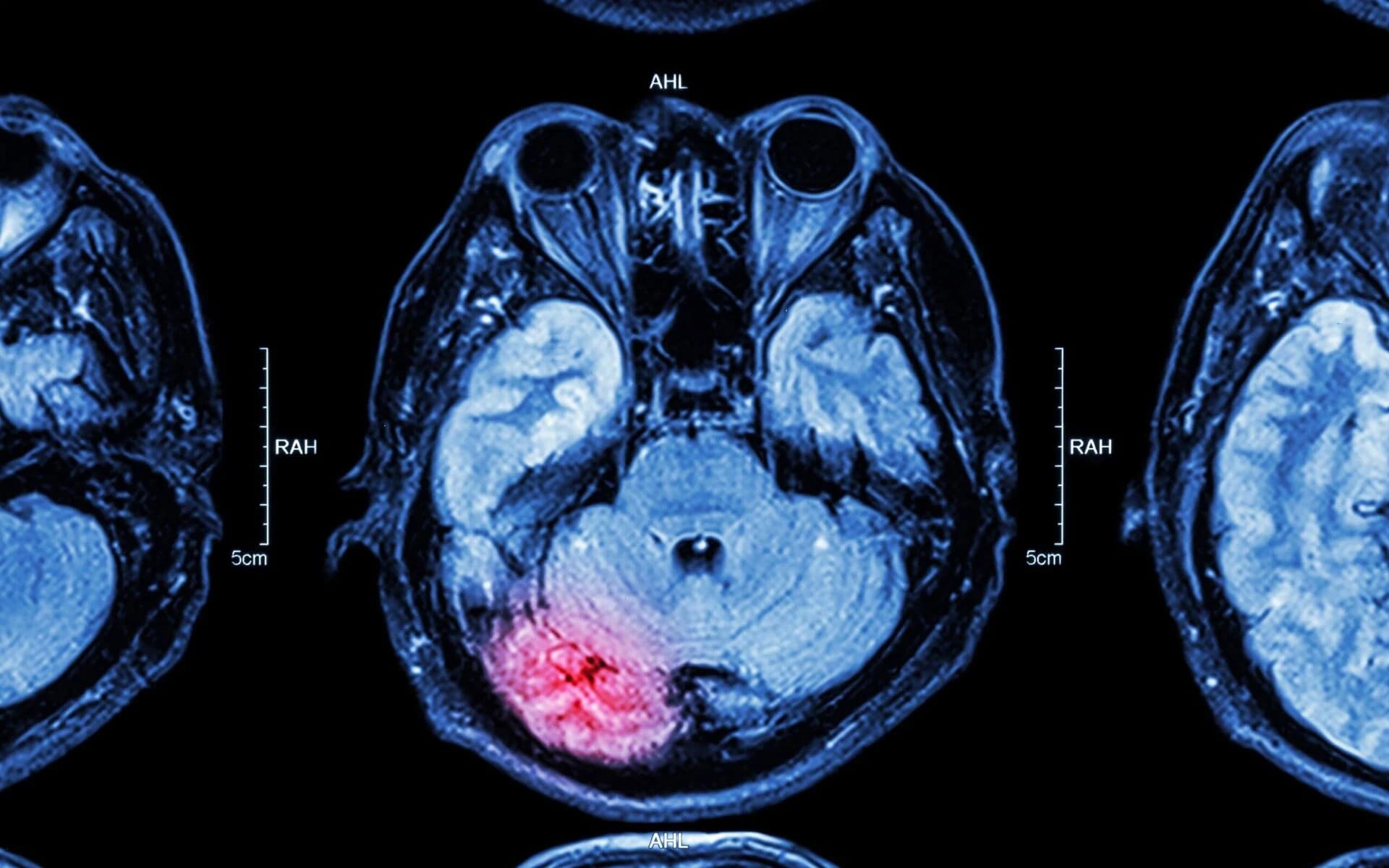Detailed brain MRI scan showing traumatic brain injury damage used by California TBI lawyers to document medical evidence for compensation claims