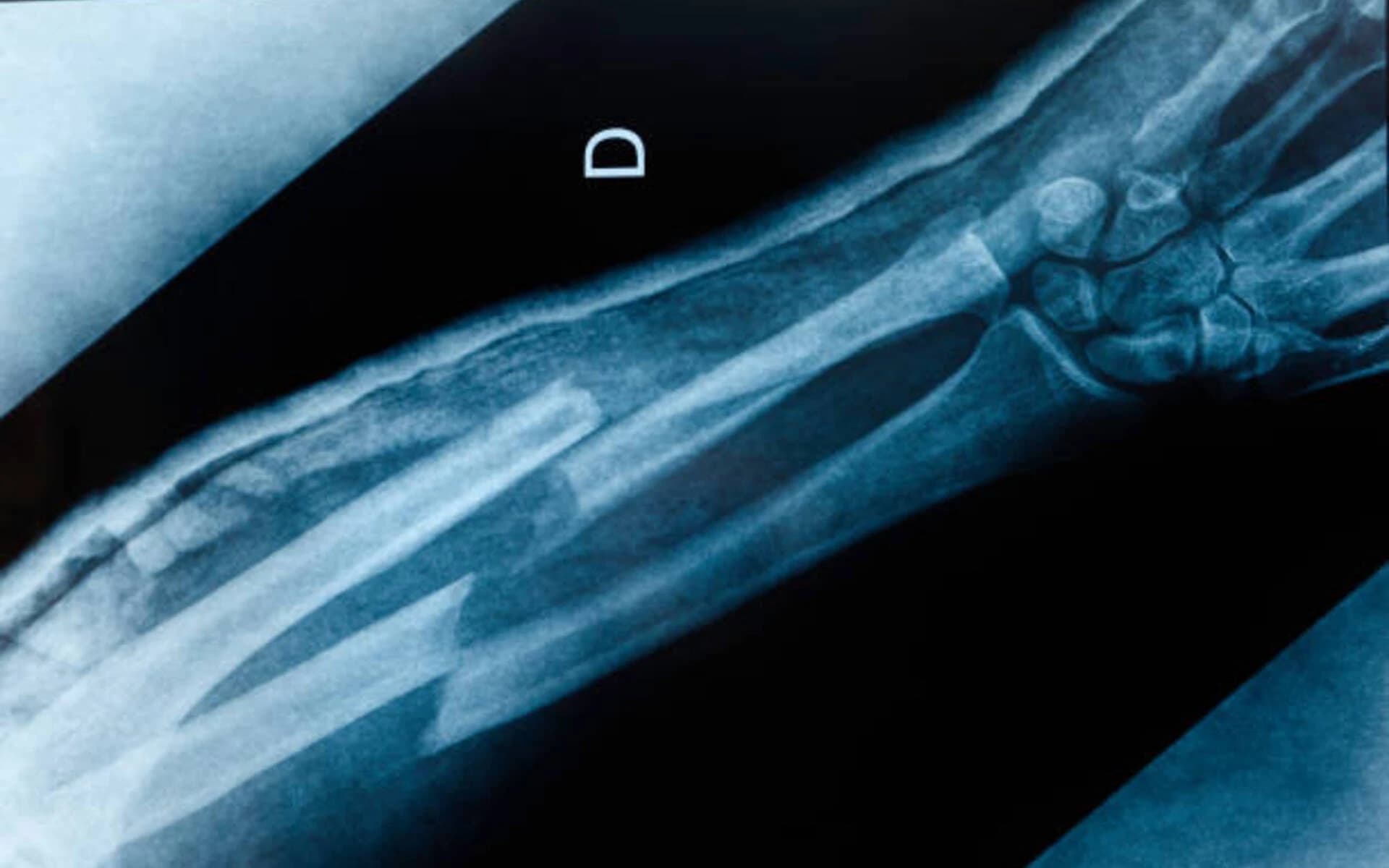 X-ray showing bone fracture from car accident injury